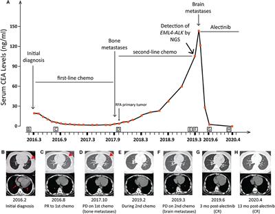 Durable Complete Response to Alectinib in a Lung Adenocarcinoma Patient With Brain Metastases and Low-Abundance EML4-ALK Variant in Liquid Biopsy: A Case Report